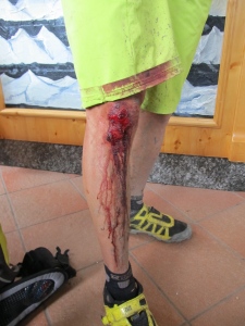 Marcus's knee after a crash. Looks worse than it was. 